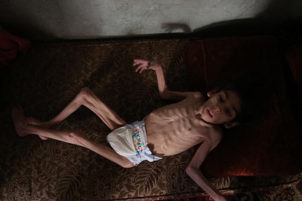 触目惊心！叙利亚8岁女童瘦到皮包骨