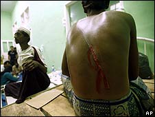 A Rohingya refugee in Indonesia shows a wound on his back (3 February)