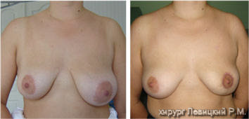 Збільшення грудей імплантами - до і після операції